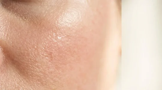 Représentation visuelle de la réparation de la barrière cutanée endommagée avec rougeurs et inflammation